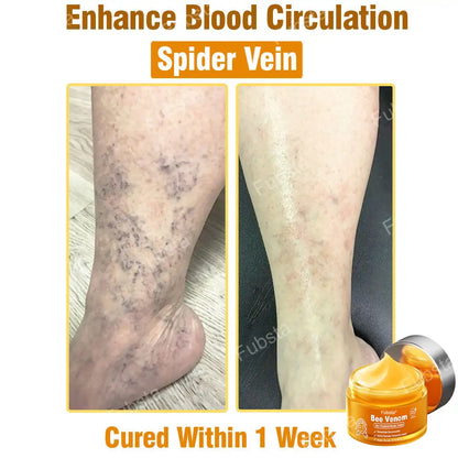 Fubsta® 𝑩𝒆𝒆 𝑽𝒆𝒏𝒐𝒎 𝑺𝒌𝒊𝒏 𝑻𝒓𝒆𝒂𝒕𝒎𝒆𝒏𝒕 𝑺𝒆𝒓𝒖𝒎 𝑪𝒓𝒆𝒂𝒎👨‍⚕️ (Suitable for all ages & TGA recommends)