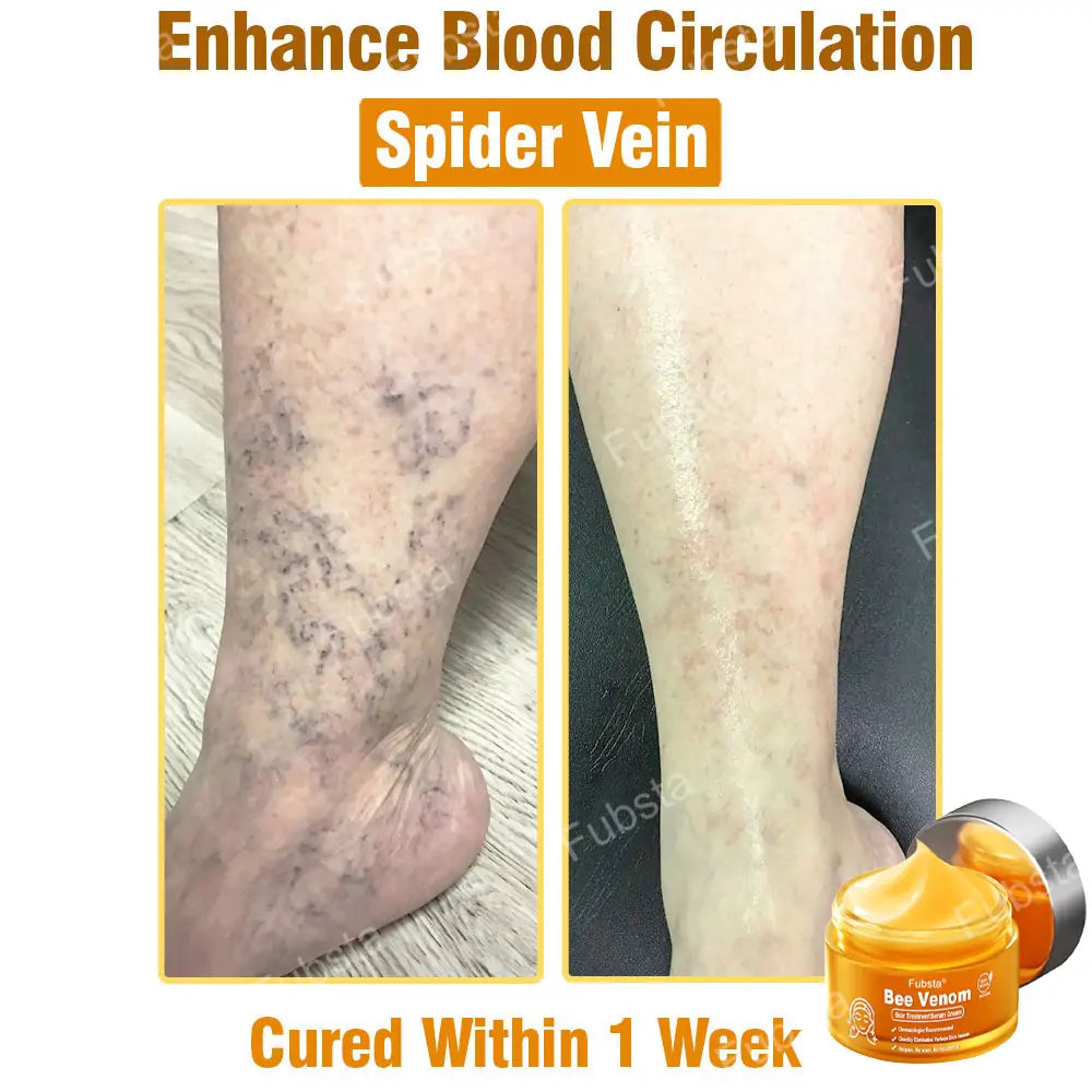 Fubsta® 𝑩𝒆𝒆 𝑽𝒆𝒏𝒐𝒎 𝑺𝒌𝒊𝒏 𝑻𝒓𝒆𝒂𝒕𝒎𝒆𝒏𝒕 𝑺𝒆𝒓𝒖𝒎 𝑪𝒓𝒆𝒂𝒎👨‍⚕️ (Suitable for all ages & FDA recommends)
