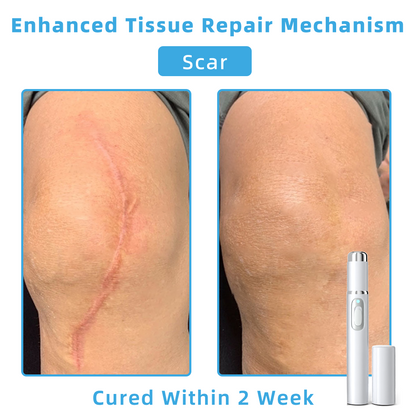 Clinically Reviewed by Mayo Clinic Experts: 👩‍⚕️Mresio® 𝑵on-i𝒏va𝒔𝒊ve 𝑴o𝒍e an𝒅 𝑾ar𝒕 𝑹emo𝒗𝒂𝒍 𝑳ase𝒓 𝑷en 𝑷roma𝒙 (Fast and painless removal of warts. moles. age spots. and skin tags — completely without side effects.)🚀