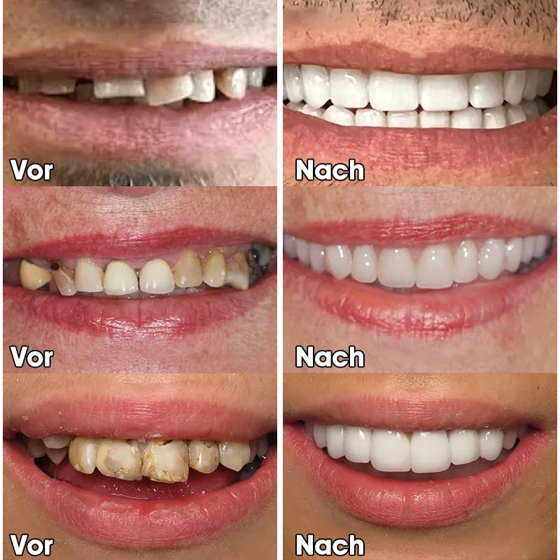 Last Day Discount - 80% Off 😁Newest 2025👨‍⚕Adjustable Snap-On Dentures💝