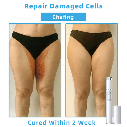 Clinically Reviewed by Mayo Clinic Experts: 👩‍⚕️Mresio® 𝑵on-i𝒏va𝒔𝒊ve 𝑴o𝒍e an𝒅 𝑾ar𝒕 𝑹emo𝒗𝒂𝒍 𝑳ase𝒓 𝑷en 𝑷roma𝒙 (Fast and painless removal of warts. moles. age spots. and skin tags — completely without side effects.)🚀