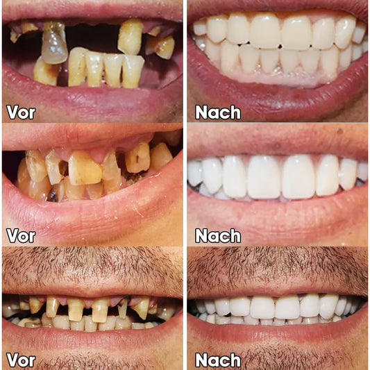 Last Day Discount - 80% Off 💝Newest 2025👨‍⚕Adjustable Snap-On Dentures😁
