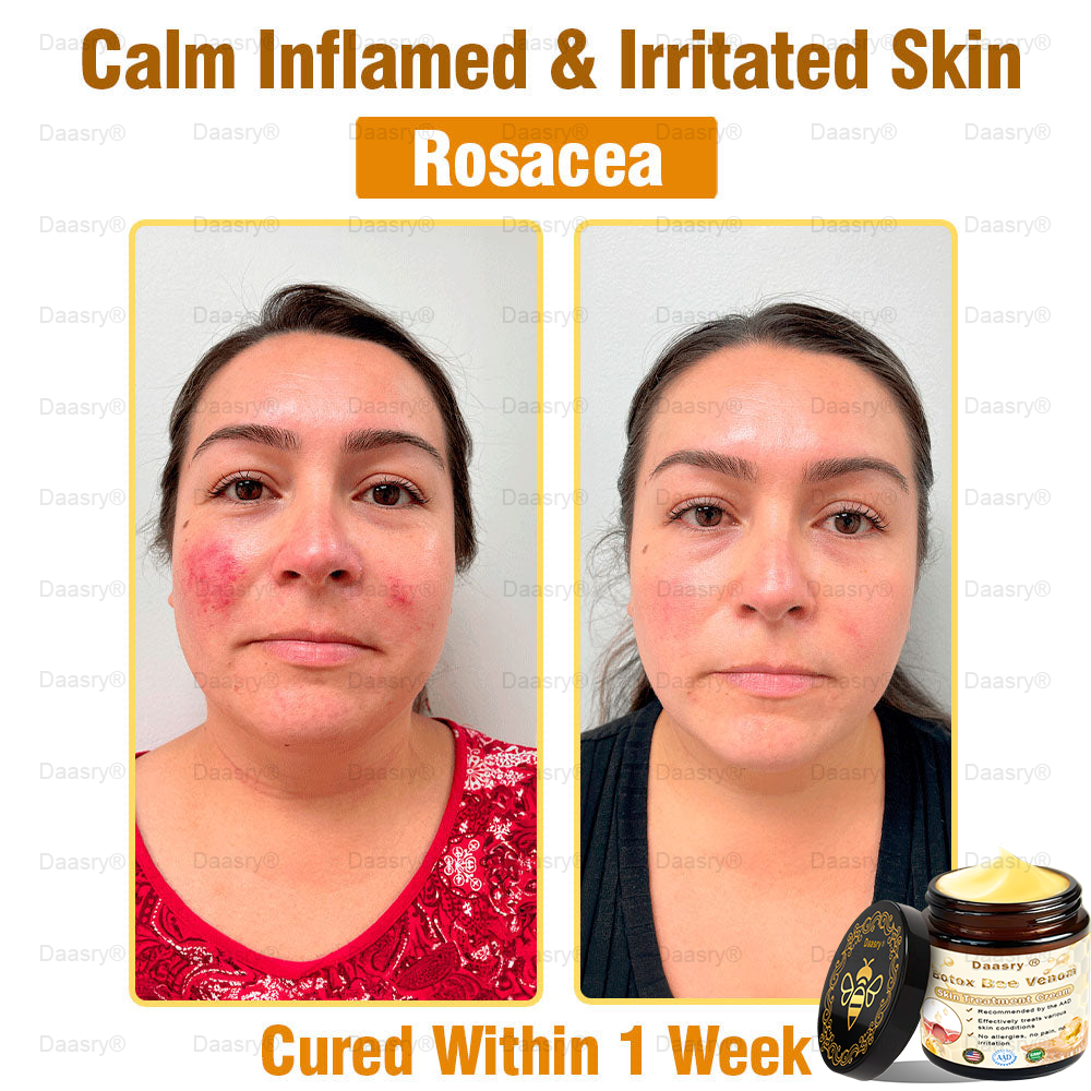CVS Pharmacy: Daasry® Botox Bee Venom Skin Treatment Cream Approved by AAD