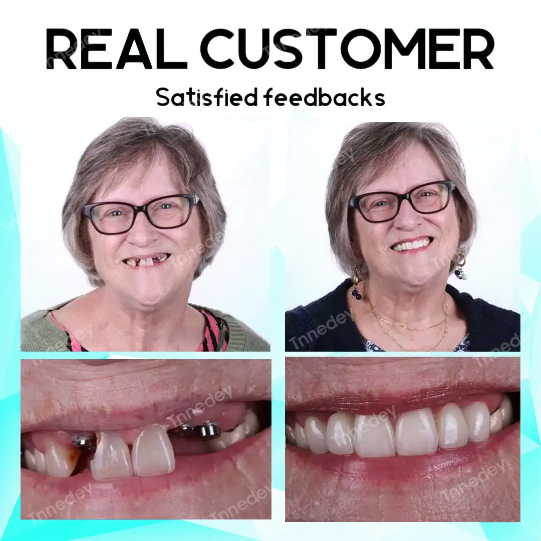 𝐋𝐚𝐬𝐭 𝐃𝐚𝐲 𝐃𝐢𝐬𝐜𝐨𝐮𝐧𝐭 - 𝟕𝟓% 𝐎𝐟𝐟 🎊Newest 2025 𝐓𝐧𝐧𝐞𝐝𝐞𝐲® Adjustable Snap-On Dentures✅🦷