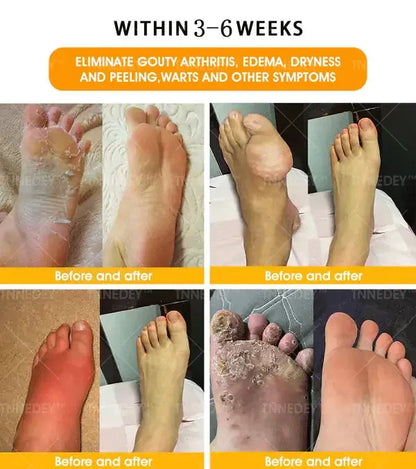 𝐋𝐚𝐬𝐭 𝐝𝐚𝐲 𝐭𝐨 𝐠𝐞𝐭 𝟕𝟎% 𝐎𝐅𝐅: 𝐓𝐧𝐧𝐞𝐝𝐞𝐲® 𝐁𝐞𝐞 𝐕𝐞𝐧𝐨𝐦 & 𝟑𝟎-𝐇𝐞𝐫𝐛 𝐃𝐞𝐭𝐨𝐱 𝐅𝐨𝐨𝐭 𝐒𝐨𝐚𝐤 𝐁𝐞𝐚𝐝𝐬 𝐟𝐨𝐫 𝐁𝐨𝐝𝐲 𝐒𝐜𝐮𝐥𝐩𝐭𝐢𝐧𝐠- Recommended by the America Lymphatic Academy (ALA) ⚡🏆