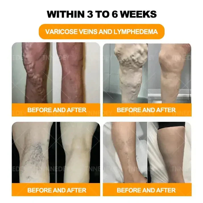 𝐋𝐚𝐬𝐭 𝐝𝐚𝐲 𝐭𝐨 𝐠𝐞𝐭 𝟕𝟎% 𝐎𝐅𝐅: 𝐓𝐧𝐧𝐞𝐝𝐞𝐲® 𝐁𝐞𝐞 𝐕𝐞𝐧𝐨𝐦 & 𝟑𝟎-𝐇𝐞𝐫𝐛 𝐃𝐞𝐭𝐨𝐱 𝐅𝐨𝐨𝐭 𝐒𝐨𝐚𝐤 𝐁𝐞𝐚𝐝𝐬 𝐟𝐨𝐫 𝐁𝐨𝐝𝐲 𝐒𝐜𝐮𝐥𝐩𝐭𝐢𝐧𝐠- Recommended by the America Lymphatic Academy (ALA) ⚡🏆
