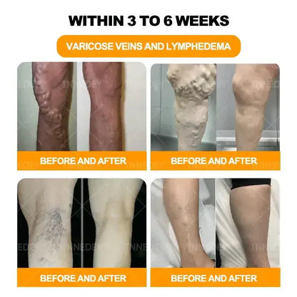 𝐋𝐚𝐬𝐭 𝐝𝐚𝐲 𝐭𝐨 𝐠𝐞𝐭 𝟕𝟎% 𝐎𝐅𝐅: 𝐓𝐧𝐧𝐞𝐝𝐞𝐲® 𝐁𝐞𝐞 𝐕𝐞𝐧𝐨𝐦 & 𝟑𝟎-𝐇𝐞𝐫𝐛 𝐃𝐞𝐭𝐨𝐱 𝐅𝐨𝐨𝐭 𝐒𝐨𝐚𝐤 𝐁𝐞𝐚𝐝𝐬 𝐟𝐨𝐫 𝐁𝐨𝐝𝐲 𝐒𝐜𝐮𝐥𝐩𝐭𝐢𝐧𝐠- Recommended by the America Lymphatic Academy (ALA) ⚡🏆