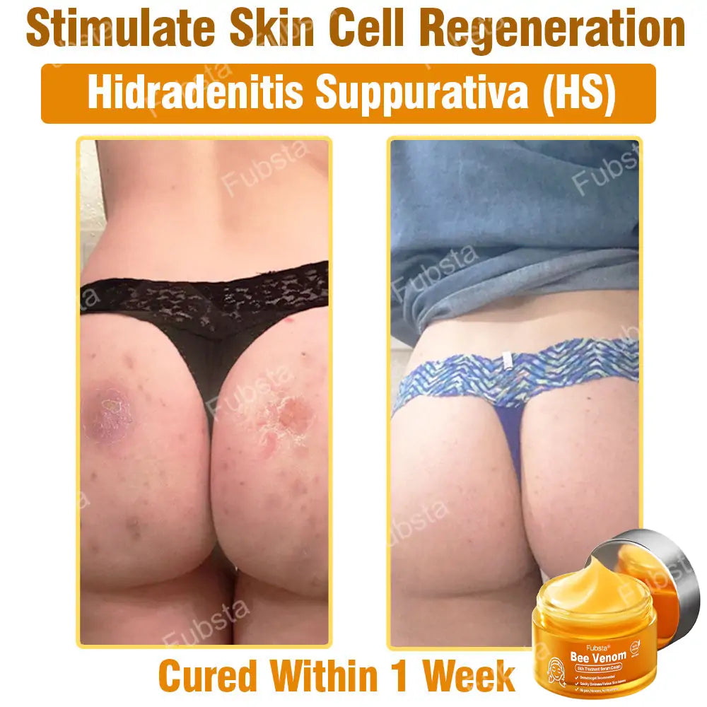 Fubsta® 𝑩𝒆𝒆 𝑽𝒆𝒏𝒐𝒎 𝑺𝒌𝒊𝒏 𝑻𝒓𝒆𝒂𝒕𝒎𝒆𝒏𝒕 𝑺𝒆𝒓𝒖𝒎 𝑪𝒓𝒆𝒂𝒎👨‍⚕️ (Suitable for all ages & TGA recommends)