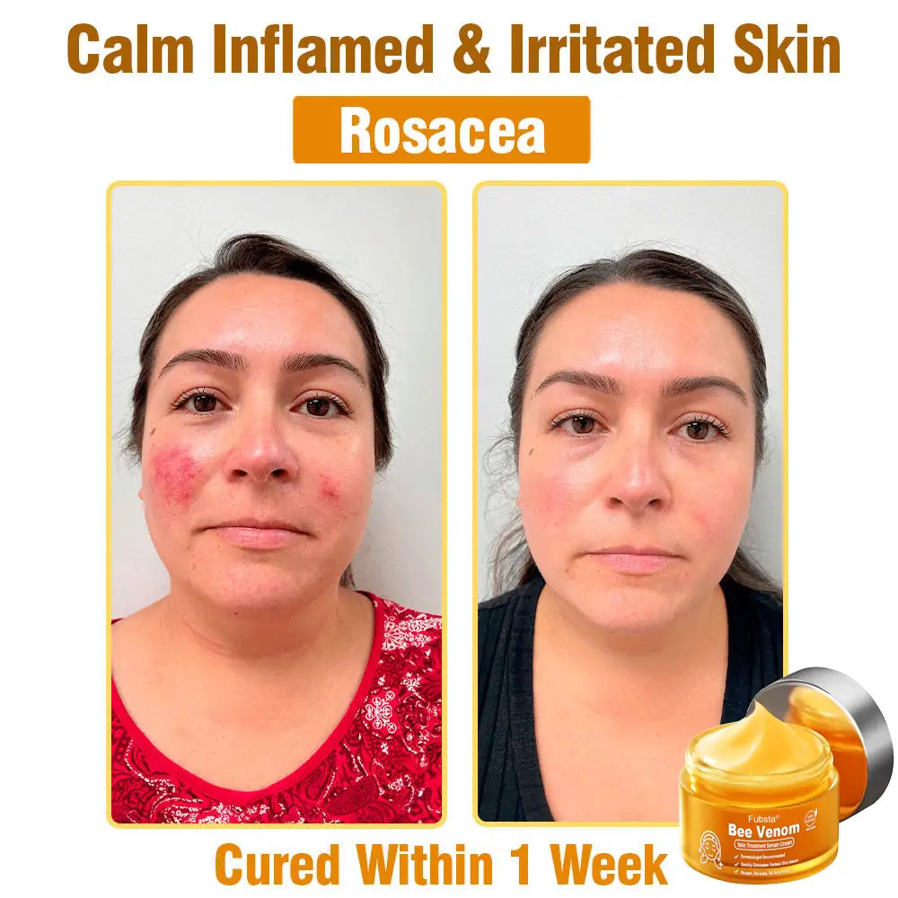 Fubsta® 𝑩𝒆𝒆 𝑽𝒆𝒏𝒐𝒎 𝑺𝒌𝒊𝒏 𝑻𝒓𝒆𝒂𝒕𝒎𝒆𝒏𝒕 𝑺𝒆𝒓𝒖𝒎 𝑪𝒓𝒆𝒂𝒎👨‍⚕️ (Suitable for all ages & TGA recommends)