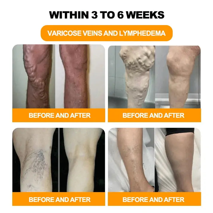 Last day to get 70% OFF: 𝐓𝐧𝐧𝐞𝐝𝐞𝐲® 𝐁𝐞𝐞 𝐕𝐞𝐧𝐨𝐦 & 𝟑𝟎-𝐇𝐞𝐫𝐛 𝐃𝐞𝐭𝐨𝐱 𝐅𝐨𝐨𝐭 𝐒𝐨𝐚𝐤 𝐁𝐞𝐚𝐝𝐬 𝐟𝐨𝐫 𝐁𝐨𝐝𝐲 𝐒𝐜𝐮𝐥𝐩𝐭𝐢𝐧𝐠- Recommended by the America Lymphatic Academy (ALA)⚡