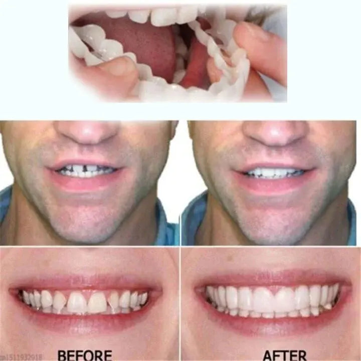 Last Day Discount - 80% Off 💝Newest 2025👨‍⚕Adjustable Snap-On Dentures😁