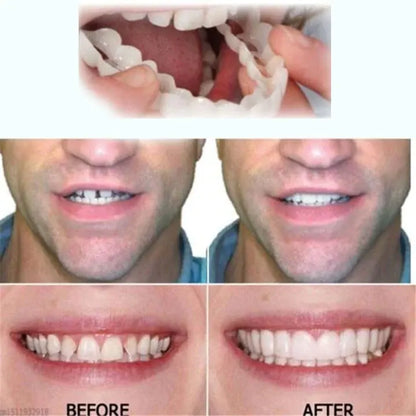 Last Day Discount - 80% Off - Newest 2025 - Adjustable Denture with Snap Dentures