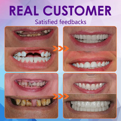 𝐁𝐢𝐤𝐞𝐧𝐝𝐚™ 𝐒𝐢𝐥𝐢𝐜𝐨𝐧𝐞 𝐑𝐞𝐥𝐢𝐧𝐞 𝐃𝐞𝐧𝐭𝐮𝐫𝐞 𝐒𝐞𝐭 (⏰ 𝐋𝐢𝐦𝐢𝐭𝐞𝐝 𝐓𝐢𝐦𝐞 𝐃𝐢𝐬𝐜𝐨𝐮𝐧𝐭 𝐋𝐚𝐬𝐭 𝟒𝟎 𝐌𝐢𝐧𝐮𝐭𝐞𝐬 ⏰) 🦷✨ - Health Canada Certified✅