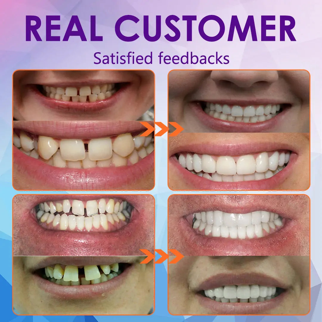 𝐁𝐢𝐤𝐞𝐧𝐝𝐚™ 𝐒𝐢𝐥𝐢𝐜𝐨𝐧𝐞 𝐑𝐞𝐥𝐢𝐧𝐞 𝐃𝐞𝐧𝐭𝐮𝐫𝐞 𝐒𝐞𝐭 (⏰ 𝐋𝐢𝐦𝐢𝐭𝐞𝐝 𝐓𝐢𝐦𝐞 𝐃𝐢𝐬𝐜𝐨𝐮𝐧𝐭 𝐋𝐚𝐬𝐭 𝟒𝟎 𝐌𝐢𝐧𝐮𝐭𝐞𝐬 ⏰) 🦷✨ - Health Canada Certified✅