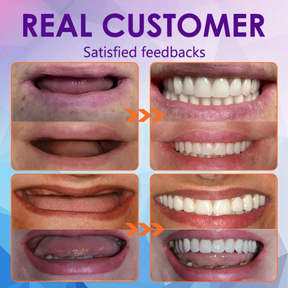 𝐁𝐢𝐤𝐞𝐧𝐝𝐚™ 𝐒𝐢𝐥𝐢𝐜𝐨𝐧𝐞 𝐑𝐞𝐥𝐢𝐧𝐞 𝐃𝐞𝐧𝐭𝐮𝐫𝐞 𝐒𝐞𝐭 (⏰ 𝐋𝐢𝐦𝐢𝐭𝐞𝐝 𝐓𝐢𝐦𝐞 𝐃𝐢𝐬𝐜𝐨𝐮𝐧𝐭 𝐋𝐚𝐬𝐭 𝟒𝟎 𝐌𝐢𝐧𝐮𝐭𝐞𝐬 ⏰) 🦷✨ - Health Canada Certified✅